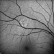Unilateral Acute Idiopathic Maculopathy - Fundus Autofluorescence Unilateral Acute Idiopathic Maculopathy - Fundus Autofluorescence